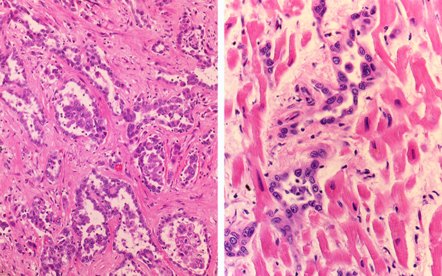 Pericardial mesothelioma H&E